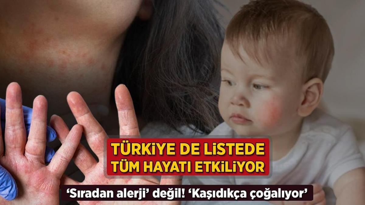 turkiye de listede tum hayati kotu etkiliyor siradan alerji degil kasidikca cogalir Kjvpli5E.jpg